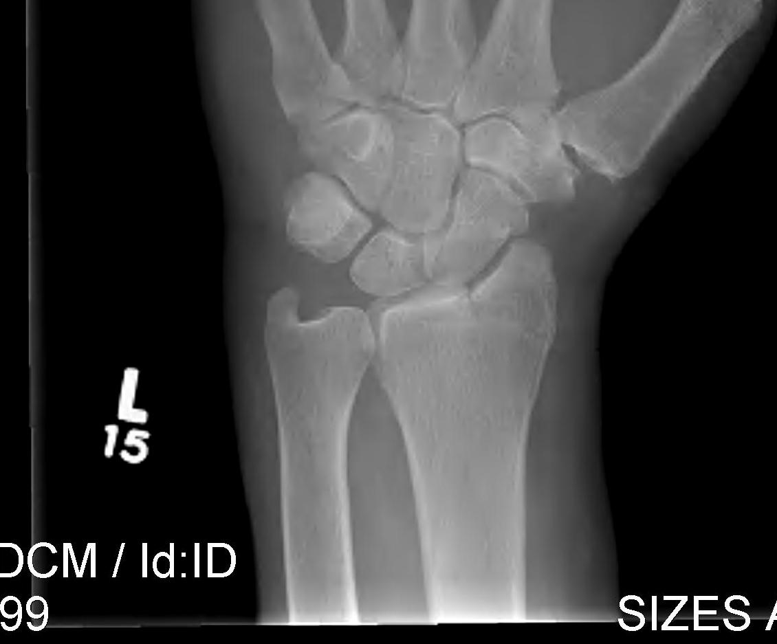 Radial styloid fracture